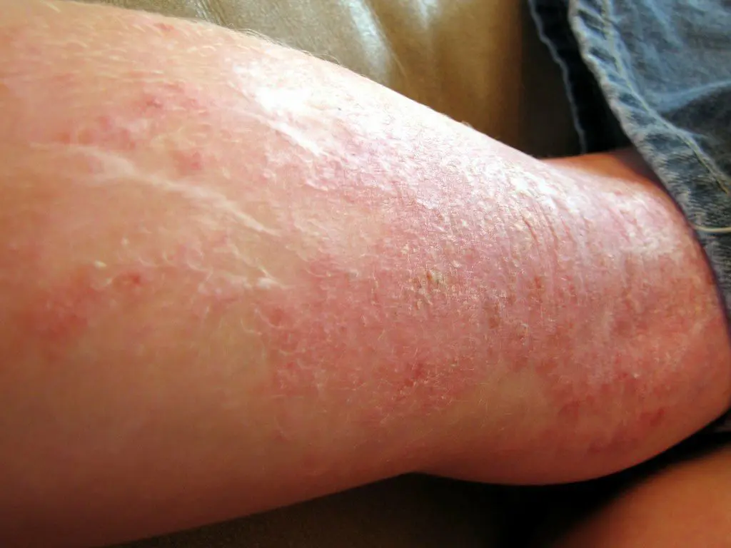 Eczema